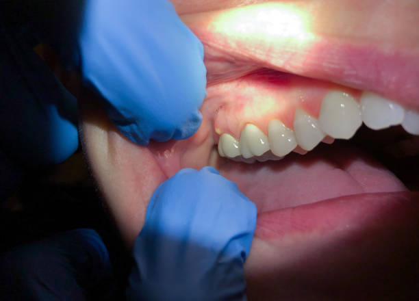 Best Emergency Dental Care for Broken or Chipped Teeth in Fairview Park, IN